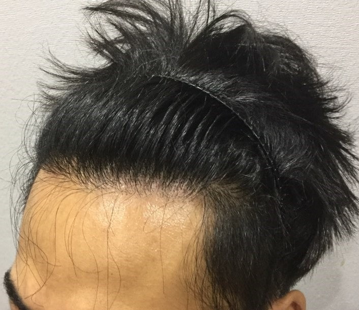 이마 이식부위 시술전