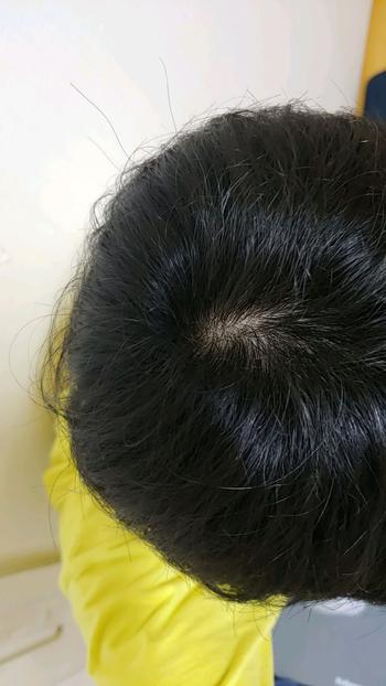 정수리 시술전