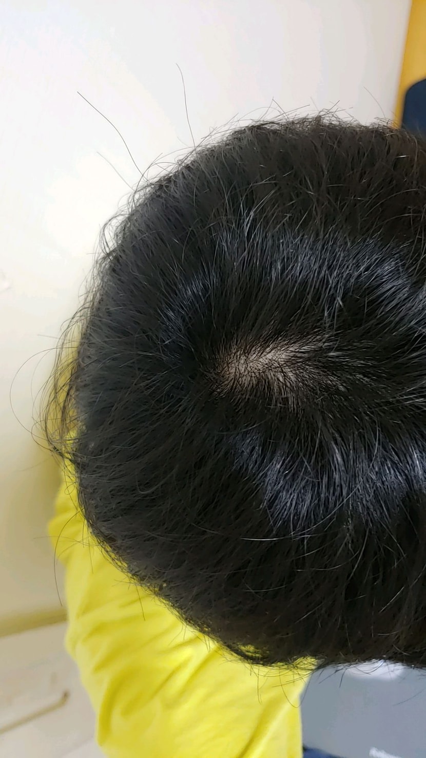 정수리 시술전