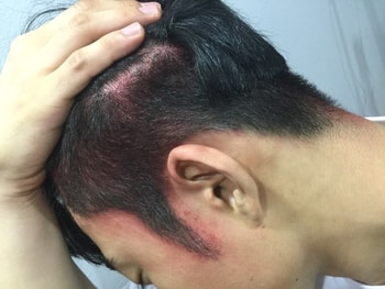 구렛나룻 옆라인 시술후