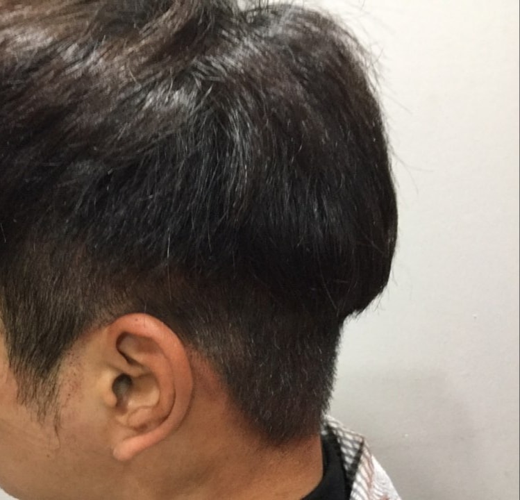 후두부 절개흉터 다른곳 두피문신+비절개 펀칭 흉터ㅜ머리 내리고