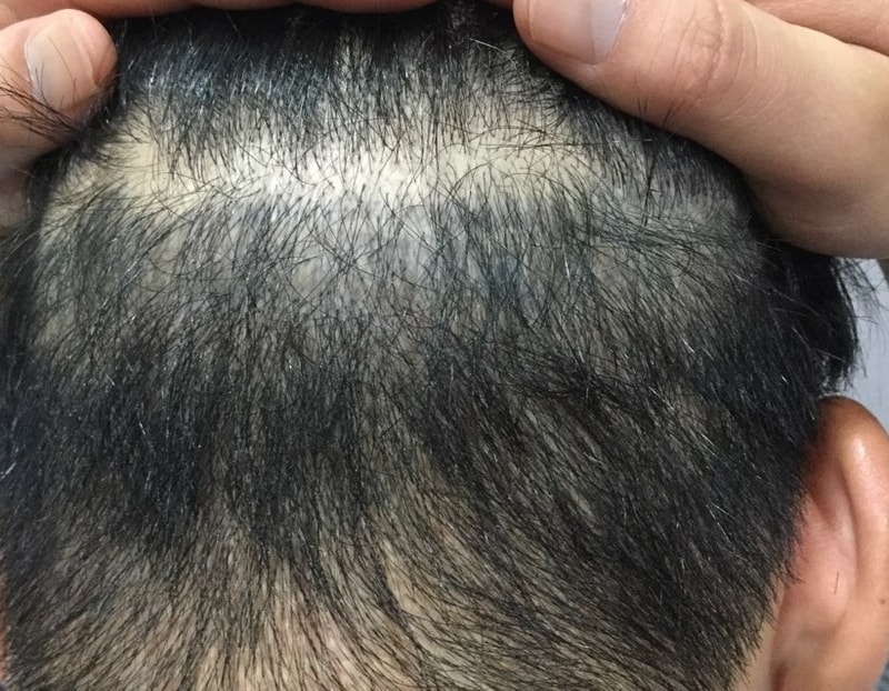 청담 미켈란의원 두피문신 후두부흉터4차 절개비절개문신+구렛나루  전체문신