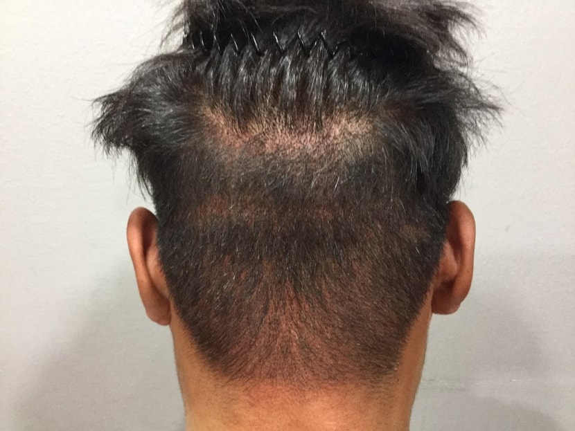 후두부 절개흉터 다른곳 두피문신+비절개 펀칭 흉터ㅜ