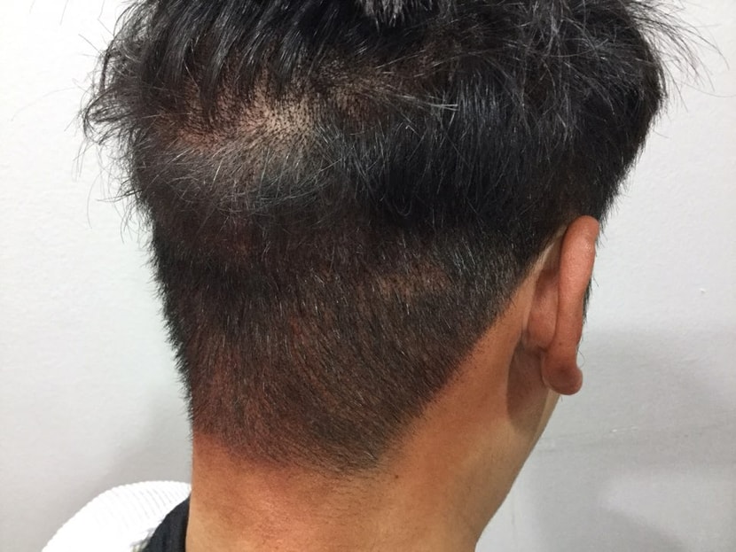 오른쪽 측면 배절개절개 두피문신후