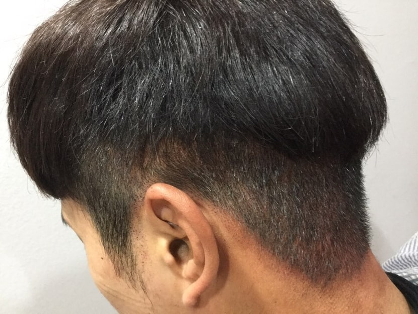 후두부 절개흉터 다른곳 두피문신+비절개 펀칭 흉터ㅜ머리 내리고