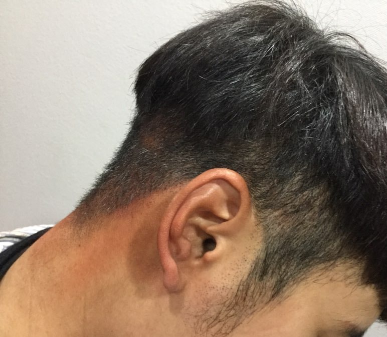 후두부 절개흉터 다른곳 두피문신+비절개 펀칭 흉터ㅜ머리 내리고