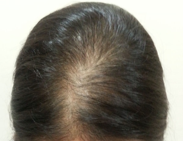 幸亏纹了头皮。