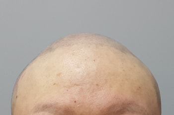 후