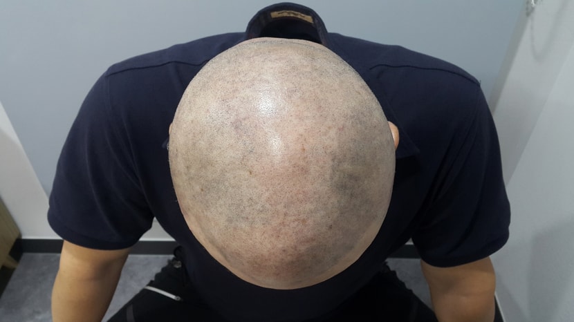 후