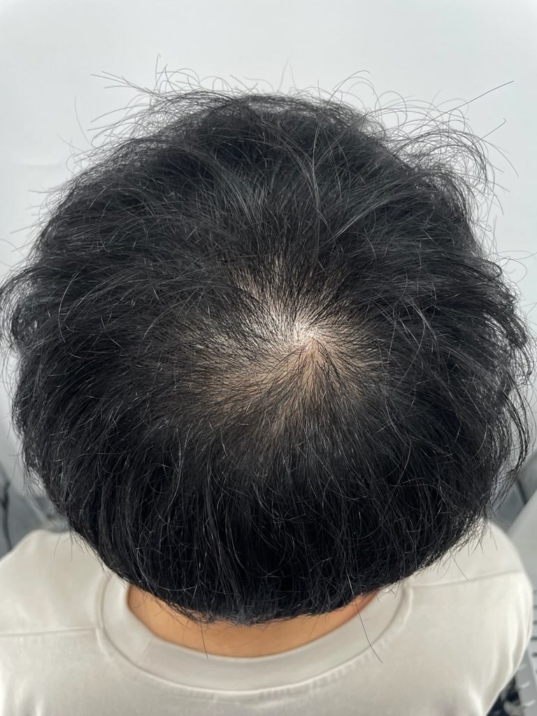 江南薄毛クリニック頭皮タトゥー病院 頭皮タトゥー体験談! さすが1位、クリニック ニューヘアー。