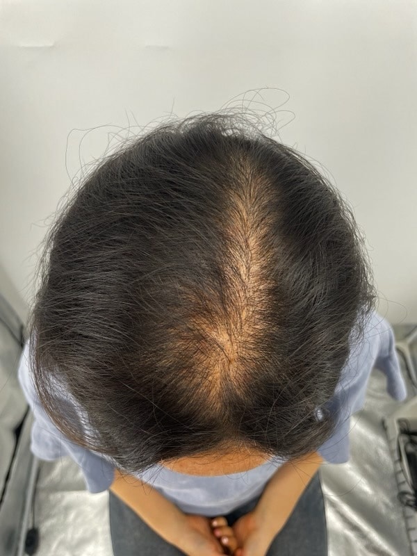 강남 두피문신 후기 / 나혼산 박나래님 탈모병원 뉴헤어성형외과 다녀옴