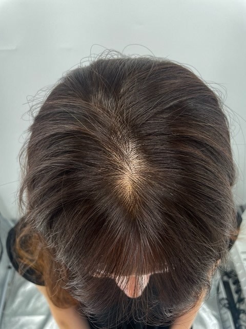 ナホンサンのパク·ナレ様を見て決めた江南頭皮ムンシン病院ニューヘアー!体験談