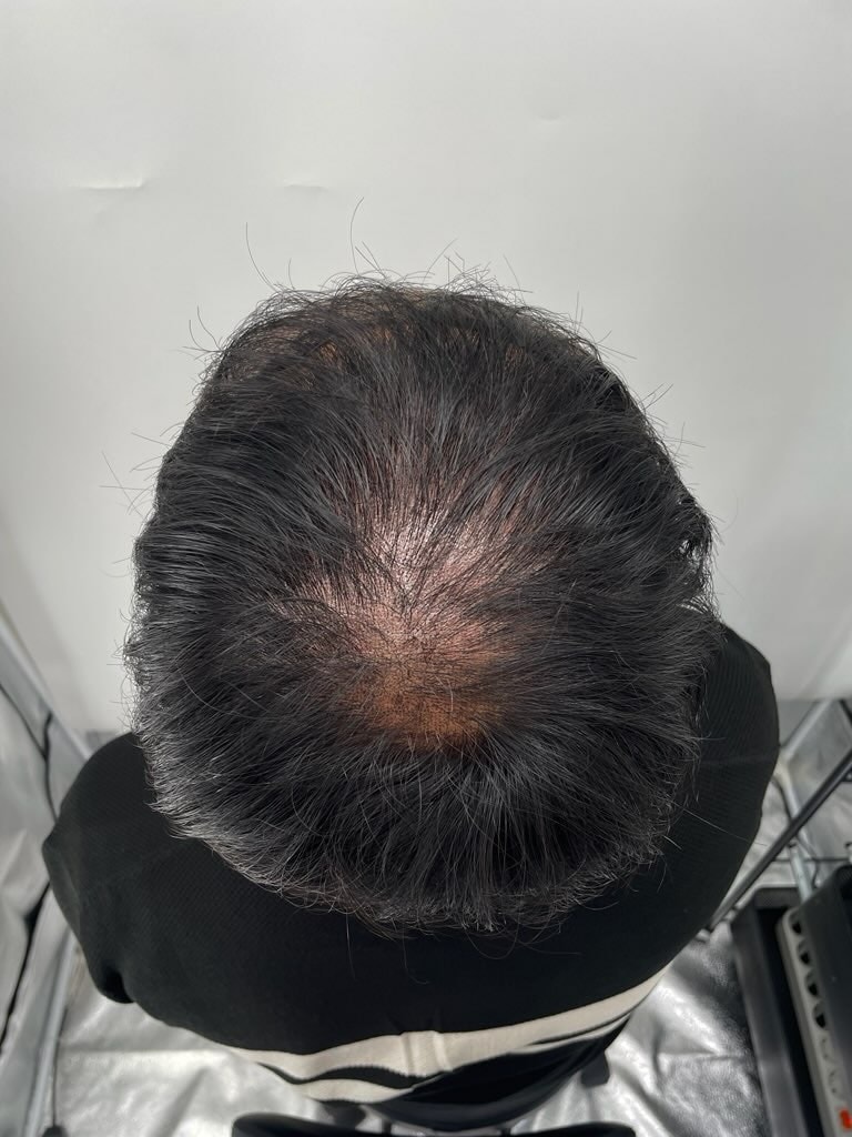 정수리가 많이 비어 보여서 많은 고민 끝에 강남 탈모병원 뉴헤어성형외과에서 두피문신을 하였습니다. 여기 금손 입니다!