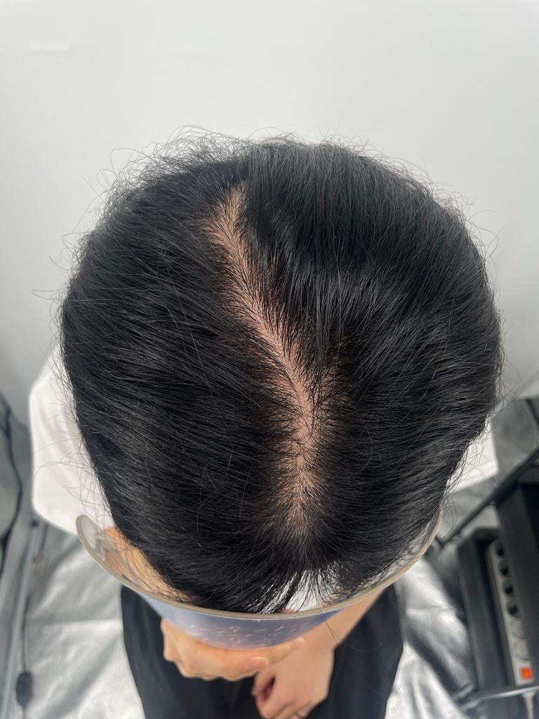 NEWHAiR 植发中心~^^头皮纹身后记，非常满意！ 第2集 发缝 朴娜莱我们村的脱发医院