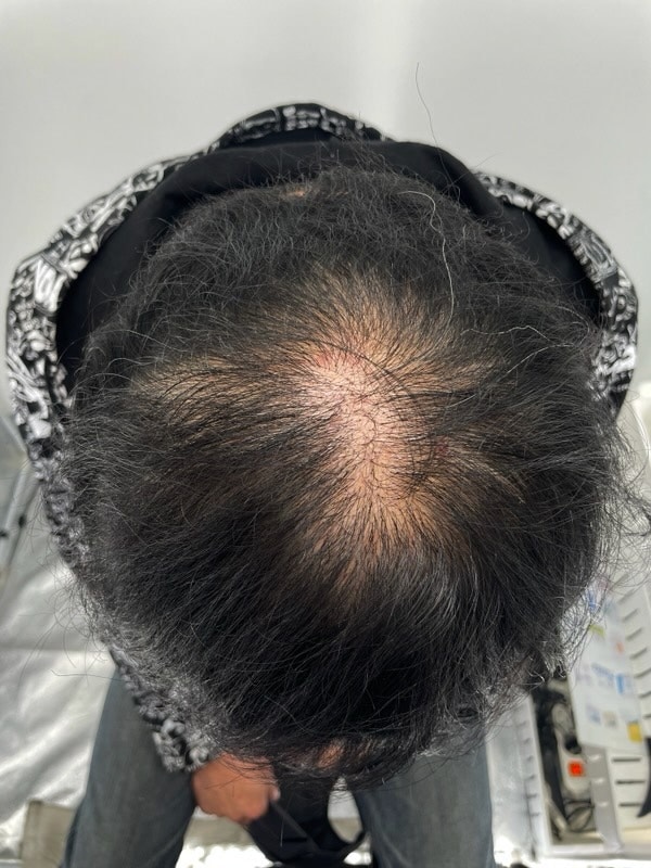 정수리 모발이식 후 두피문신!! 잘 알아보고 받으니 만족도가 아주 높습니다
