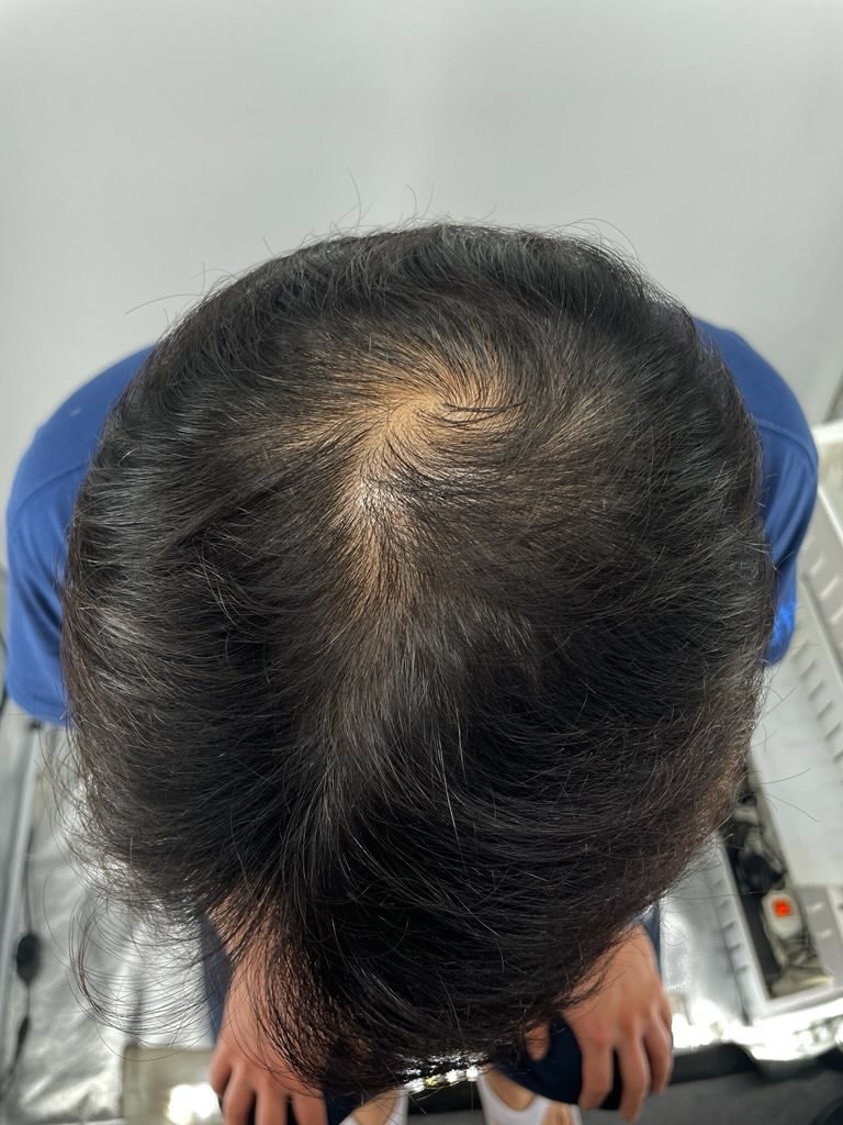 江南薄毛クリニック ニューヘアー頭皮タトゥー体験談ジン