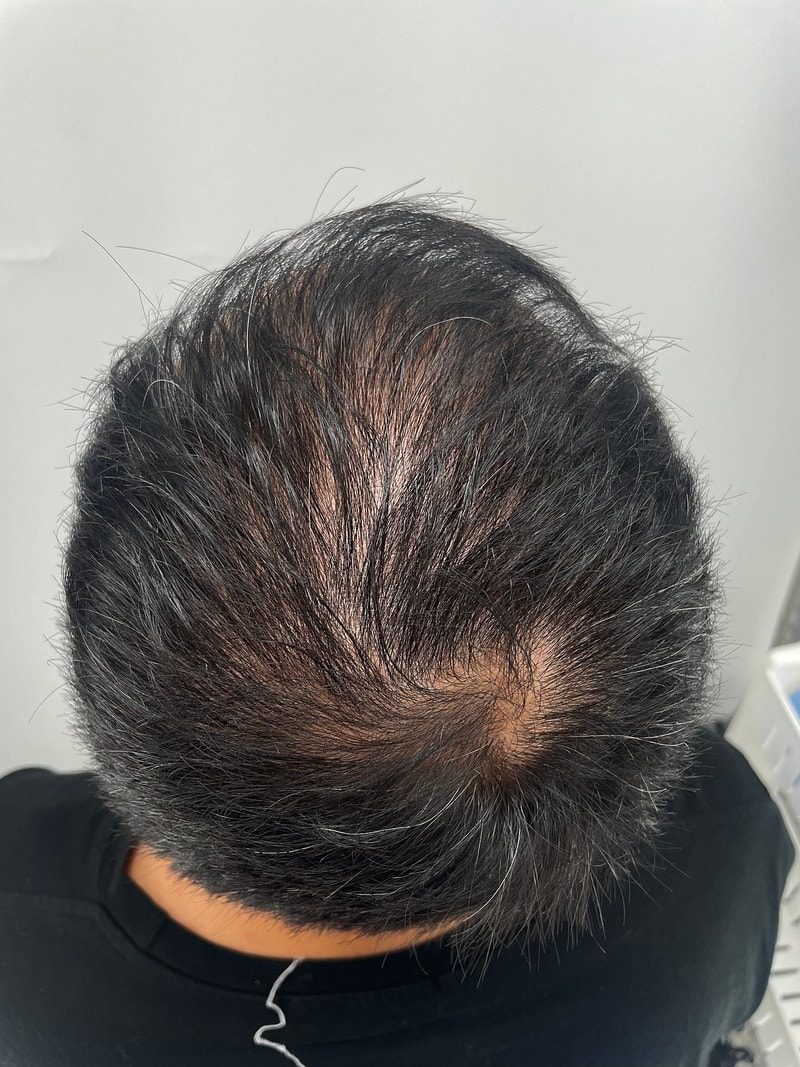 ニューヘアー頭頂頭皮タトゥー体験談