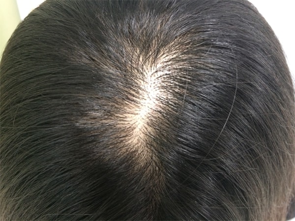 두피문신 받은지 일주일~ 후기 신고하네용!