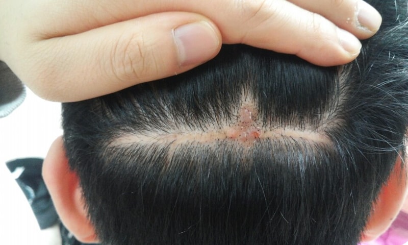 我做了疤痕纹身修复。效果不错