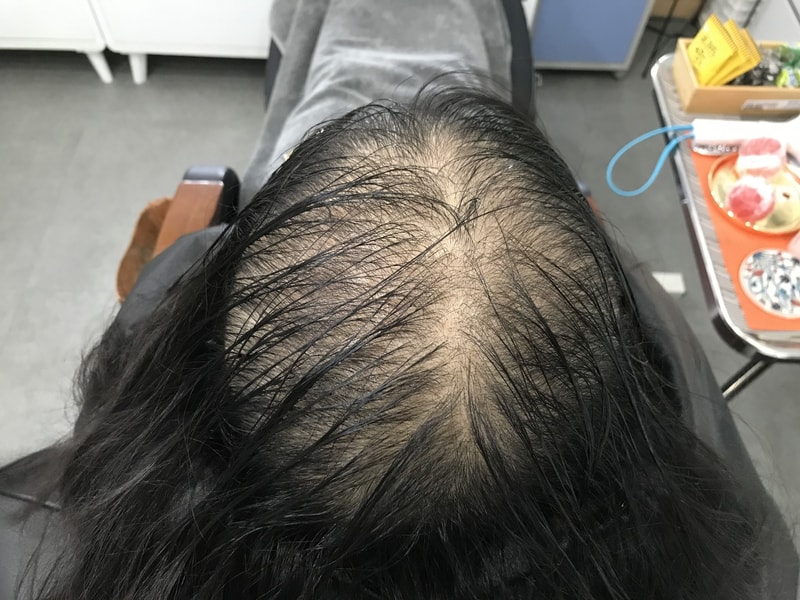 这是头皮纹身1次手术后记。