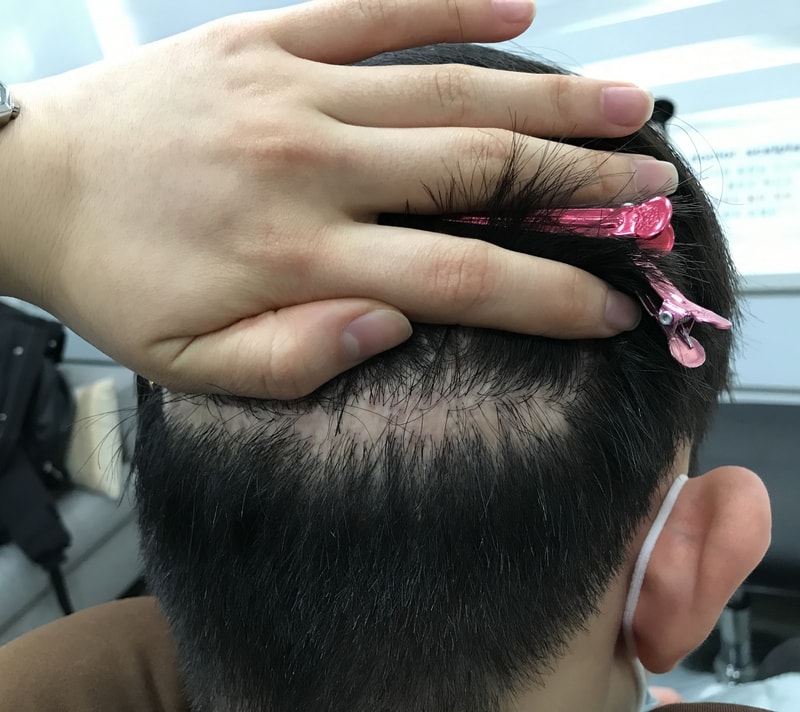 I got a scalp tattoo on my scar.