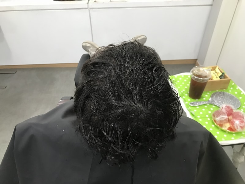 [頭皮タトゥー] 延世ミダイン医院の 2回目のリタッチ体験談です。