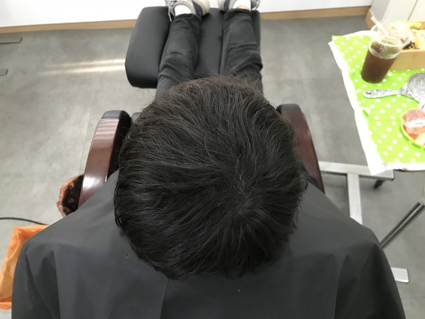 시술후