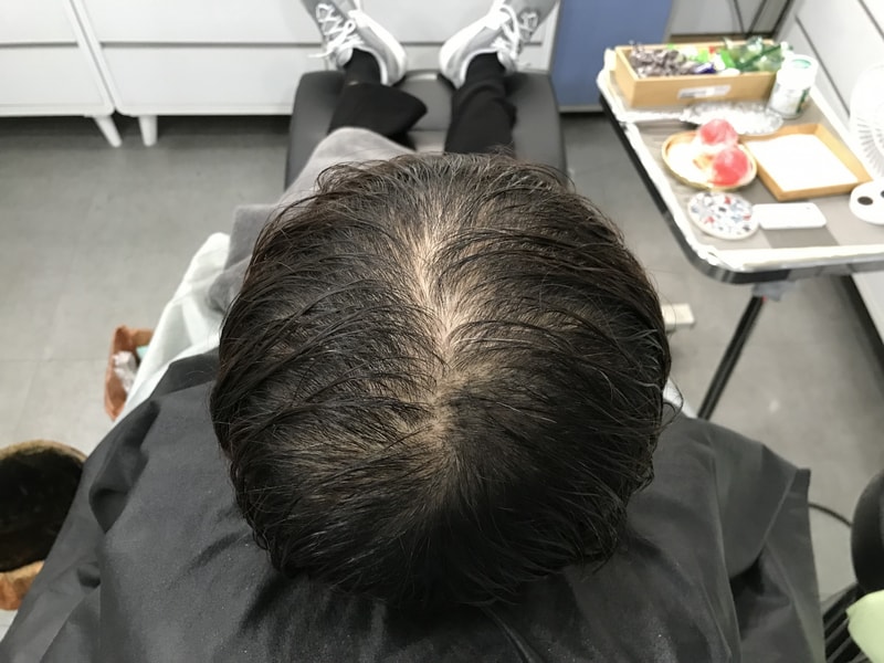 グラデーションドットの1次施術体験談です。