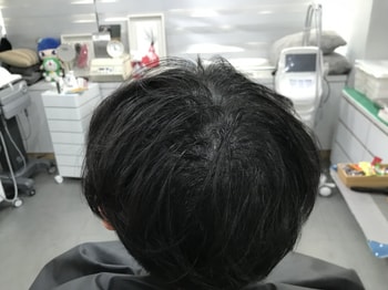 시술후3