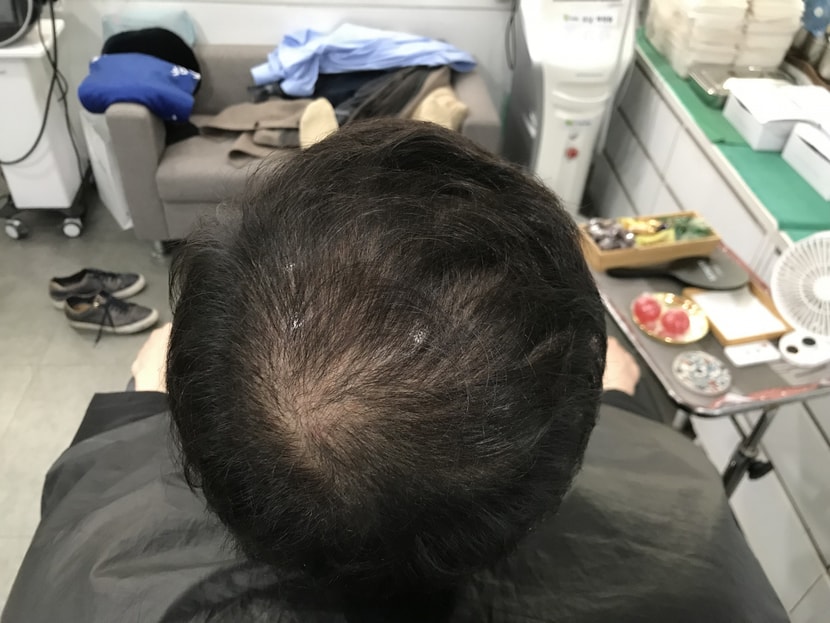 시술전 사진