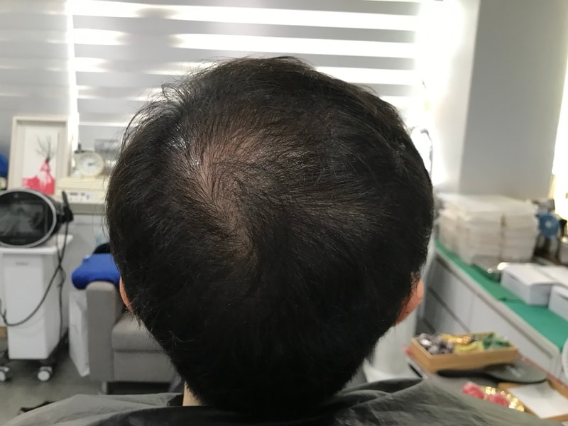 手术后100天试用的头皮纹身后记