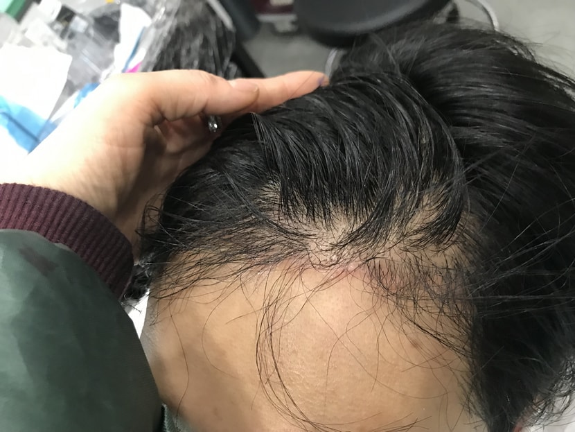 시술 전 모습입니다