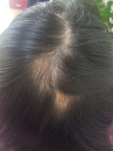 I got my scalp tattooed with circular hair loss