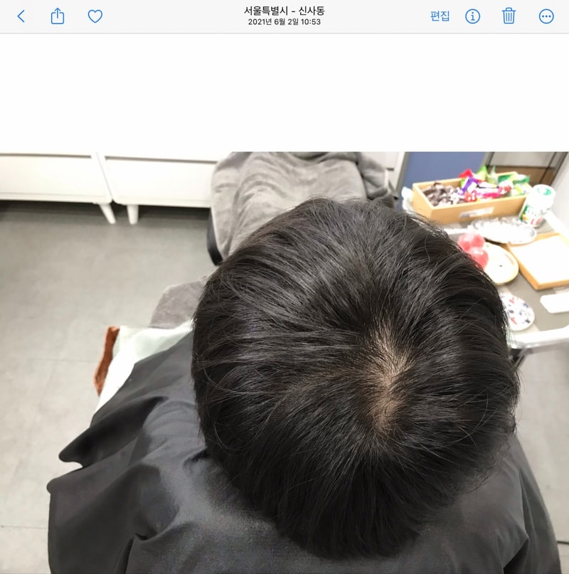 头皮纹身4年后期