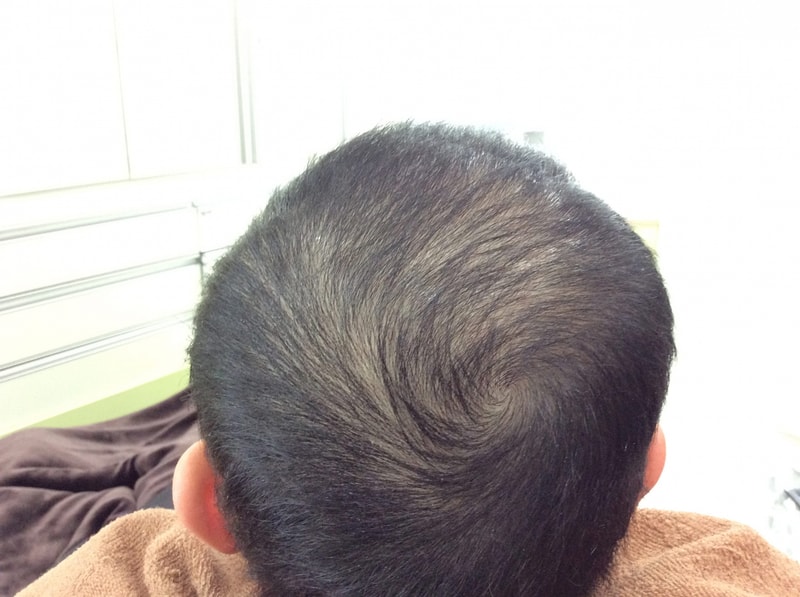 sc遮瑕术后记（图）