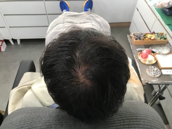 시술 전1