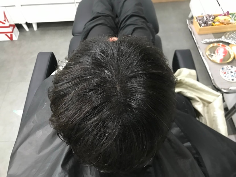 시술 후4