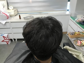 시술 후3