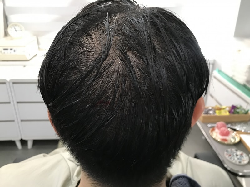 頭皮タトゥー後記