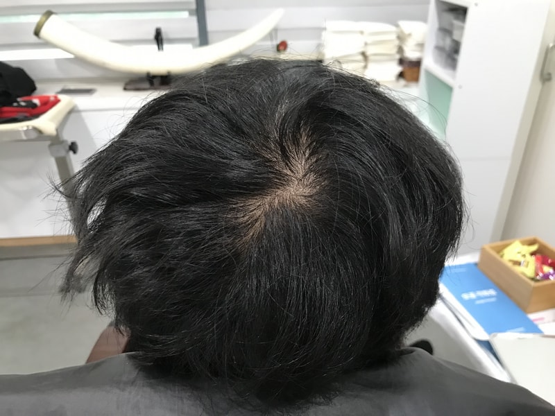 頭頂部マルチプル smp施術体験談