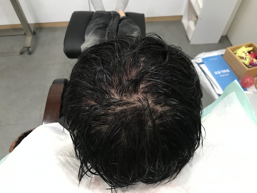 시술 전 젖은 머리 