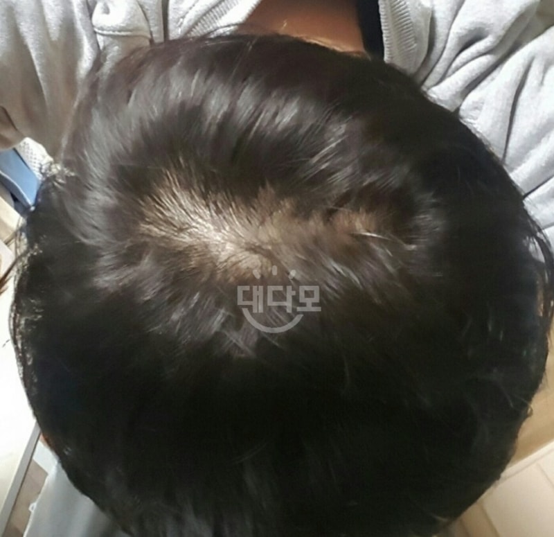头皮纹身2次后期