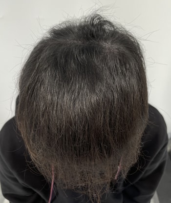 두피문신 후