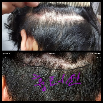 후두부흉터 &두피색소4개월 후