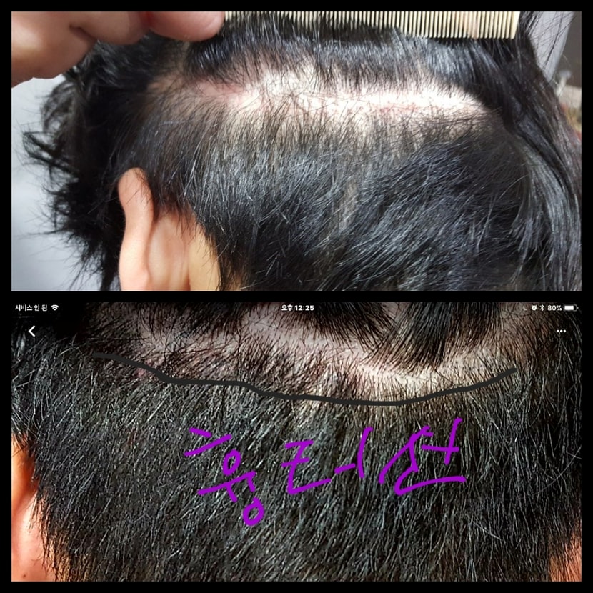 후두부흉터 &두피색소4개월 후