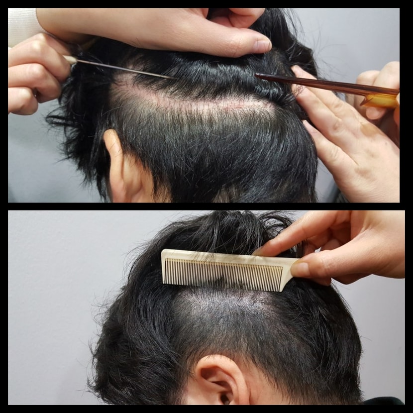 두피색소 (전) 과  두피색소 4개월 후
