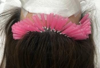 헤어라인 잔머리 재생술 치료
