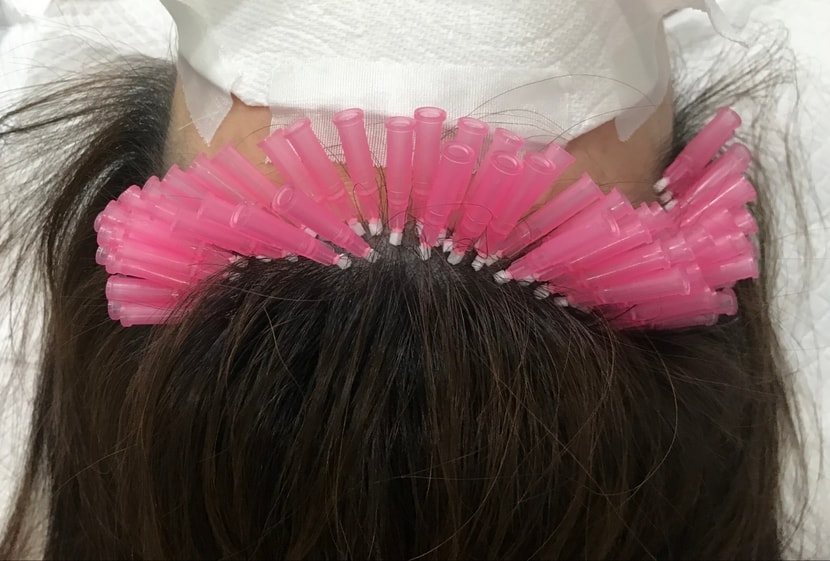 헤어라인 잔머리 재생술 치료