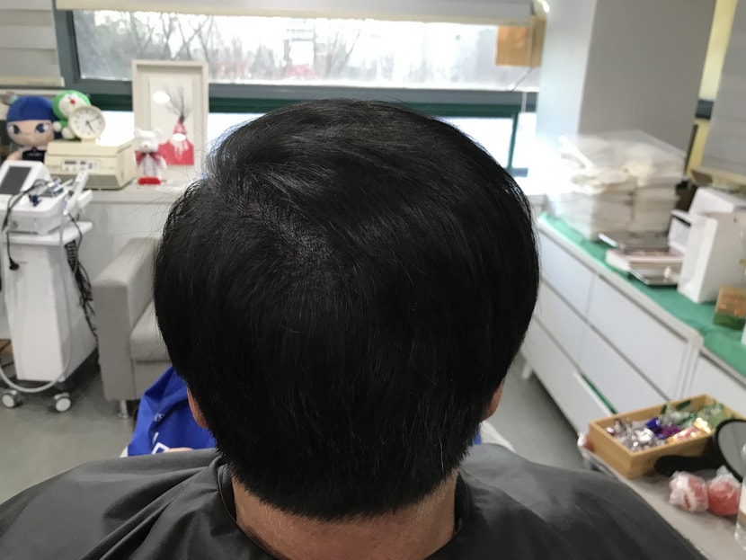 시술후