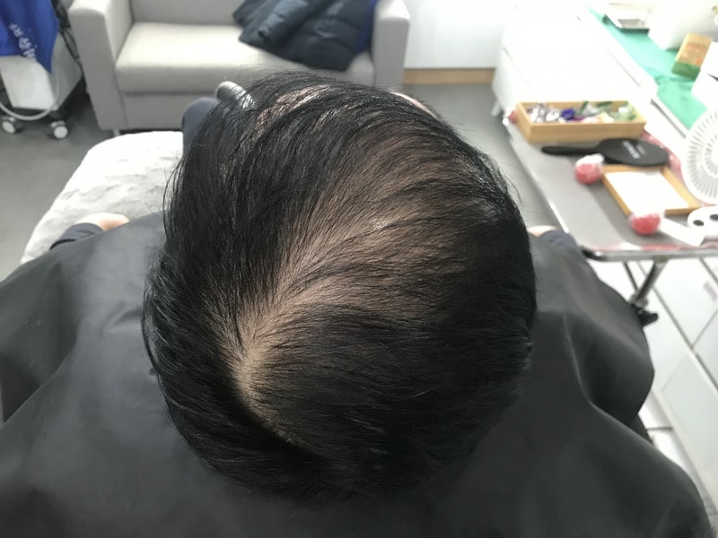 이번엔 아빠대신 쓰는 두피문신 후기입니다!